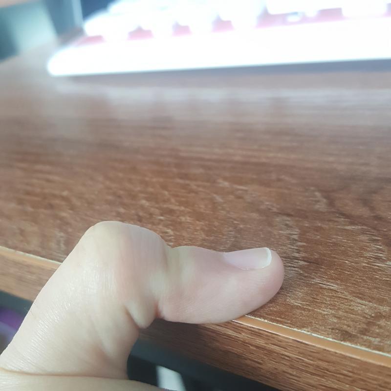 새끼손가락 꺾어짐