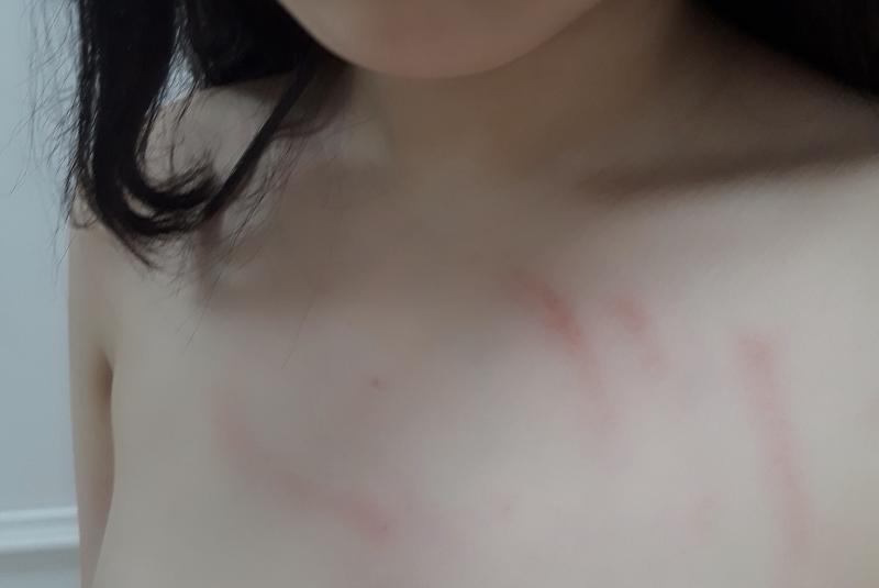 그리고 그때 생긴 상처들