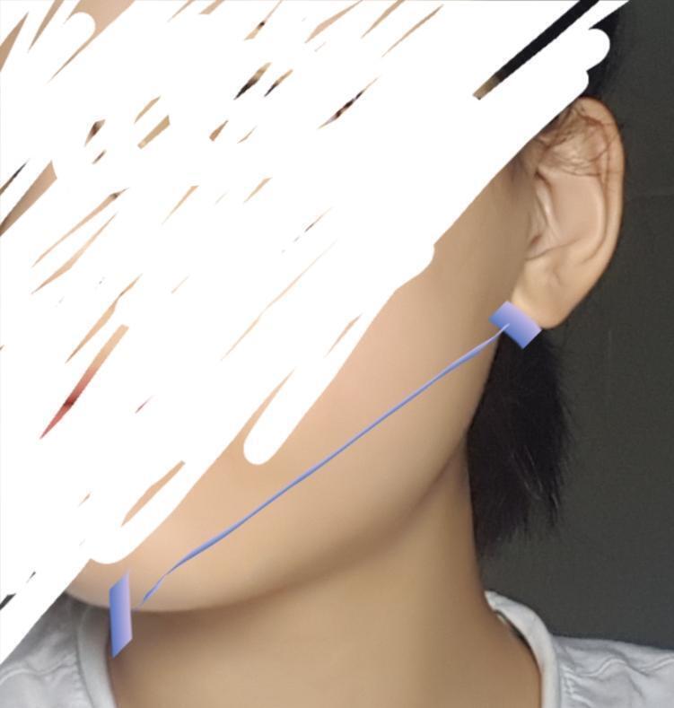 귓볼에서 턱 중앙까지의 길이 다르다는거 작년에 치과로 교정상담중에 처음 알았음 ;;