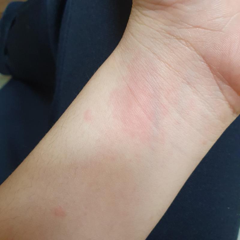 다른데도 심하기는 한데 일단 손목만 찍어봤어...근디 저것보다는 빨간색이 더 진해..