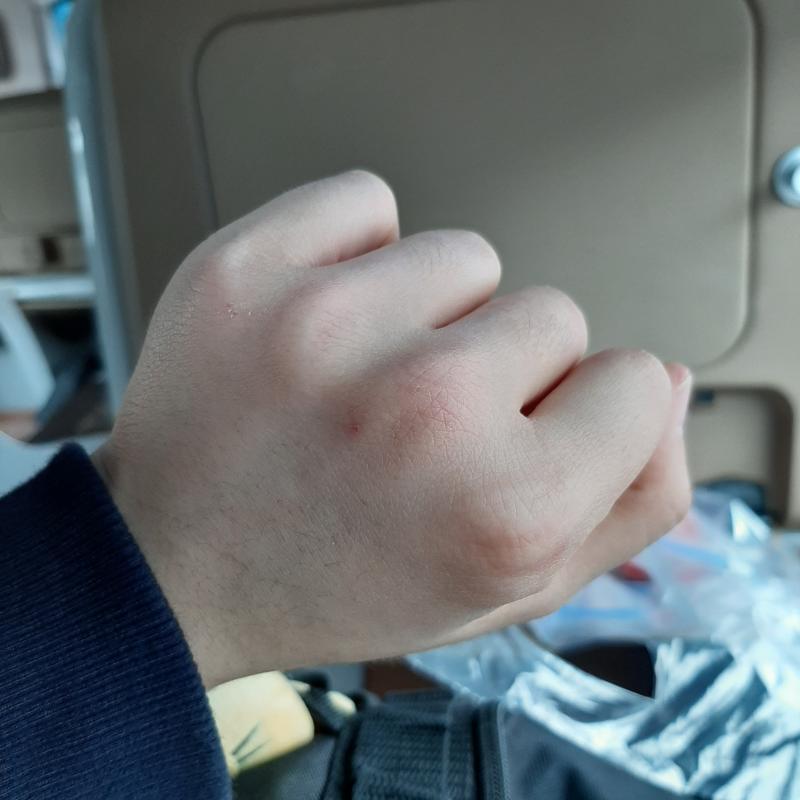 >>5 ㅇㅈ.. 이것밖에 안 까졌더라..? 진정되고나서 갑자기 손가락이 한마디만 아프길래 뭐야 하고 봤는데 반지가 아주 손가락을 꽉 물고있더라고