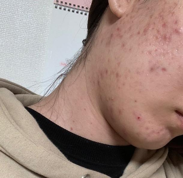 진짜 혐짤수준이라 올리기도 민망하다... 피부과 가면 어떤걸 해야할지 머 그런거 추천좀.... 피부과는 한번도 가본적이 없어..