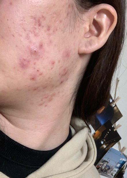 진짜 혐짤수준이라 올리기도 민망하다... 피부과 가면 어떤걸 해야할지 머 그런거 추천좀.... 피부과는 한번도 가본적이 없어..