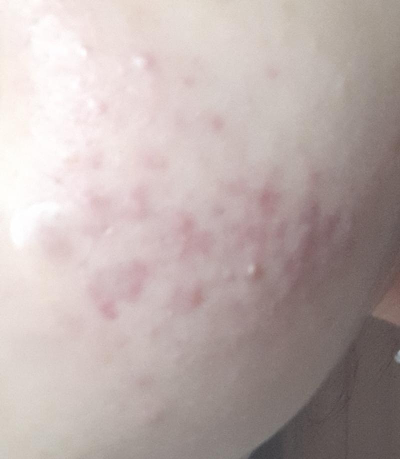 이때가 저 사진 한달 이후야 엄청 심해졌지? 나 이때 얼굴도 못들고다녓어 ,, 피부과 가서 엄청 고생했었어 진짜 너무너무 아팠다