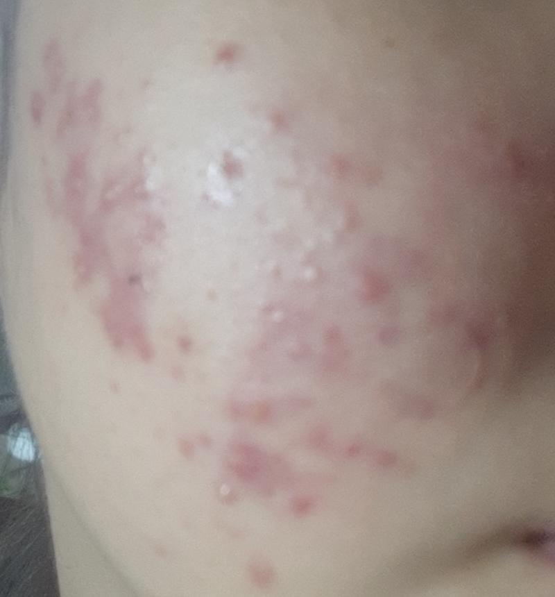 이때가 저 사진 한달 이후야 엄청 심해졌지? 나 이때 얼굴도 못들고다녓어 ,, 피부과 가서 엄청 고생했었어 진짜 너무너무 아팠다