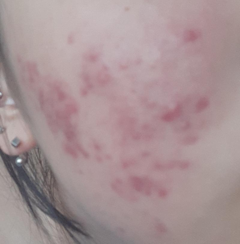 >>7 일주일후야 대박이지??? 나도 이때 사진보면 어떻게 이렇게 심하지? 생각도 들고 진짜 죽고싶엇을거같은데 ..