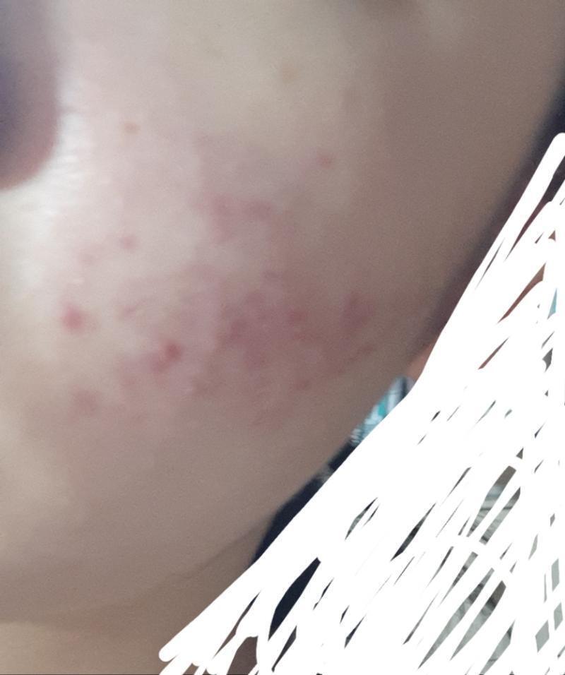 이때 2019년 9월이엇어 내가 피부가 원래 지성이엇고 여드름은 몇개몇개 잇엇고 자국도 몇개잇엇어 내가 남친 만난다고 피부가 숨을 못쉬게 피부화