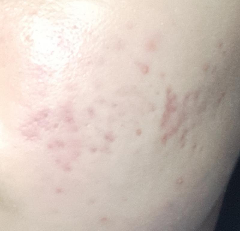 >>25 3주?정도 지낫을때야 이때 레이저 치료 받고 진정됫을때야 그래도 많이 좋아졋지ㅠㅠㅠㅠ