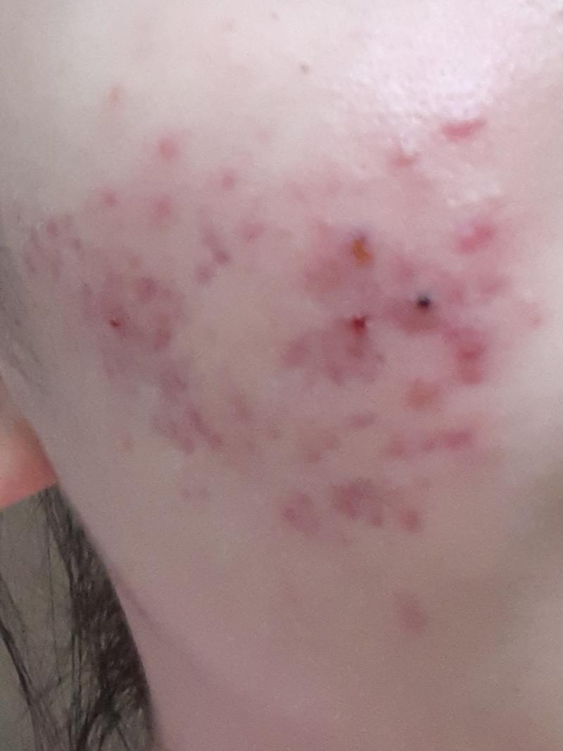 이건 >>20 일주일후 정도야! 내가 피부가 하얘서 이런 빨간 자국이 엄청 잘보여.. 이거는 피부과 가서 여드름치료 받고 온거고 압출이랑 팩하구