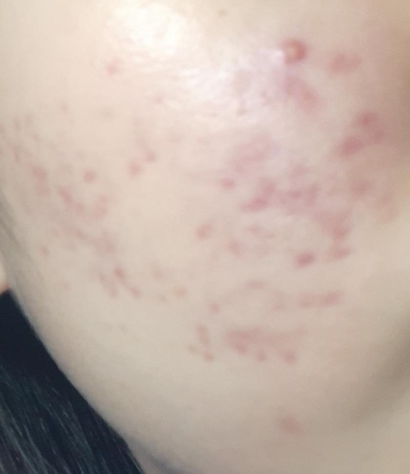 >>25 3주?정도 지낫을때야 이때 레이저 치료 받고 진정됫을때야 그래도 많이 좋아졋지ㅠㅠㅠㅠ