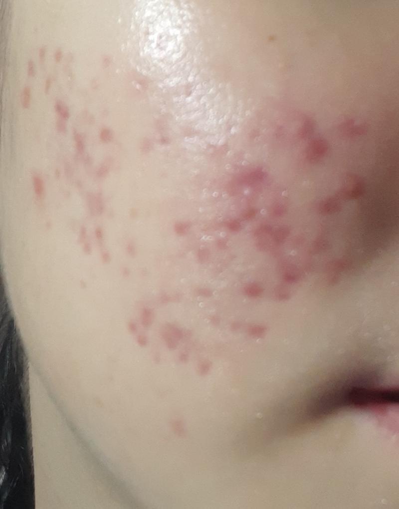 >>23 일주일후! 여드름이 거의 다 들어간거 보이지? 여드름이 진정되고 압출할게 없으면 그후에 자국을 없애기위해서 레이저를 받는거야
