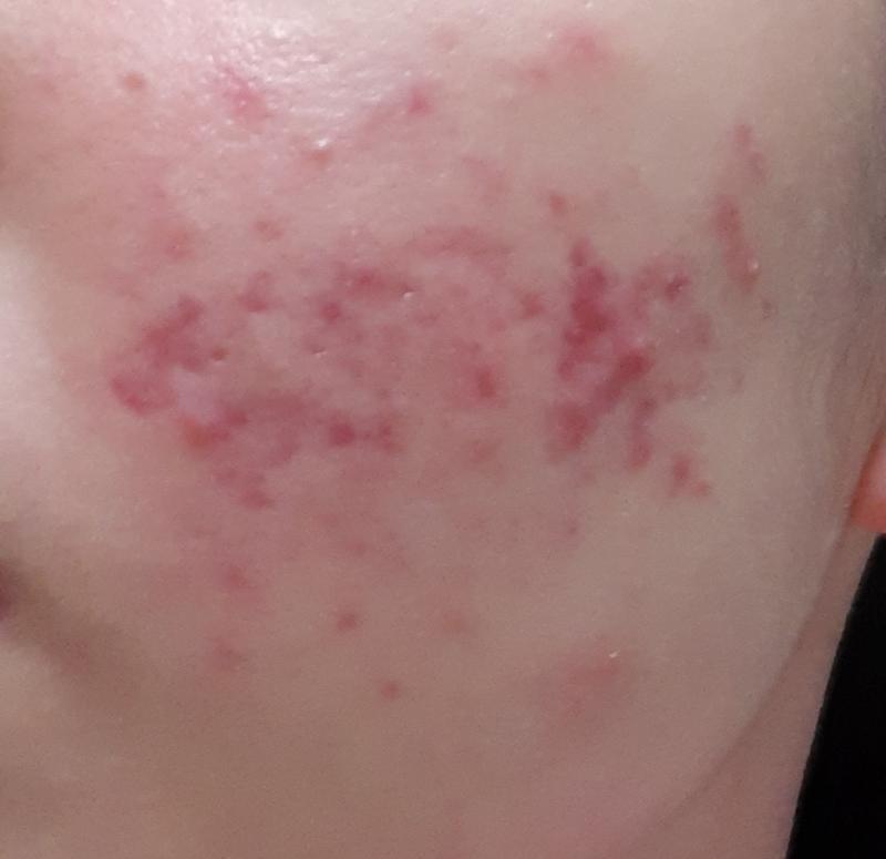 이건 >>20 일주일후 정도야! 내가 피부가 하얘서 이런 빨간 자국이 엄청 잘보여.. 이거는 피부과 가서 여드름치료 받고 온거고 압출이랑 팩하구
