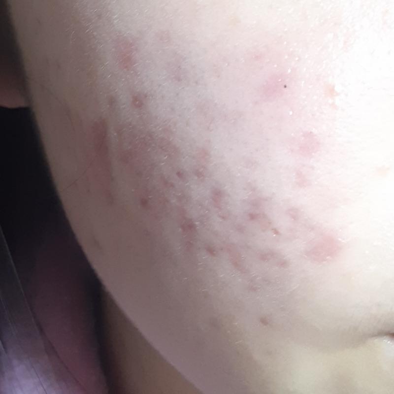 >>26 한달후인 3월이야 래이저 치료 받앗구