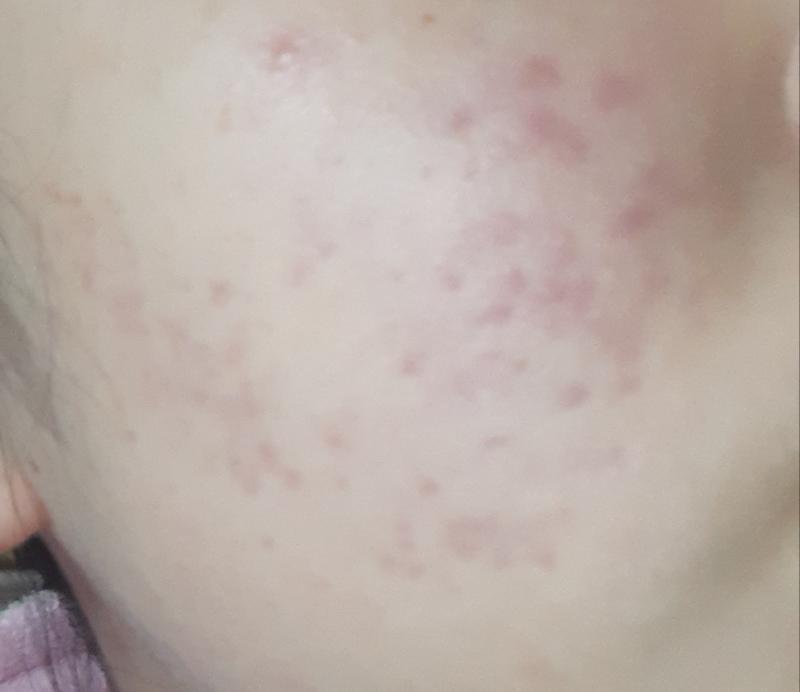 이게 지금 피부상태 !! >>27 후에 레이저치료 한번더 받앗어 많이좋아졋지ㅠㅠㅠㅠ