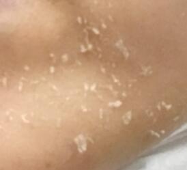 >>11 내가사진을찾아봣는데 1번 그림이라면 백반증이라고 피부질환중에 하나야 이건 피부질환이라서 어쩔수없이 병원을가야해.. 우리가 아프면 병원을