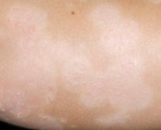 >>11 내가사진을찾아봣는데 1번 그림이라면 백반증이라고 피부질환중에 하나야 이건 피부질환이라서 어쩔수없이 병원을가야해.. 우리가 아프면 병원을