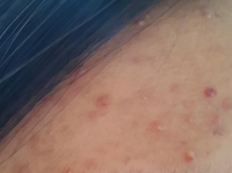 생긴건 좁쌀여드름처럼 생긴것같은데.. 여드름짜면 알갱이같은게 아니라 하얀 액체? 랑 피만 나와..ㅠㅠ