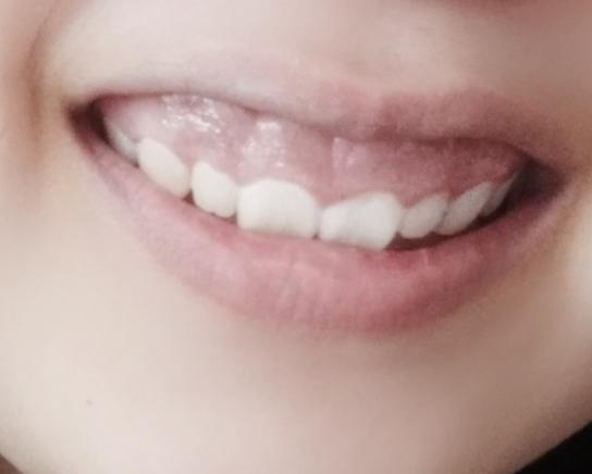 나 이게 살짝 웃은거.. 잇몸 끝까지 다보임 별명이 잇몸만개