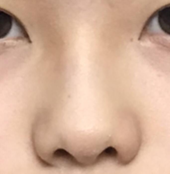 내 코..