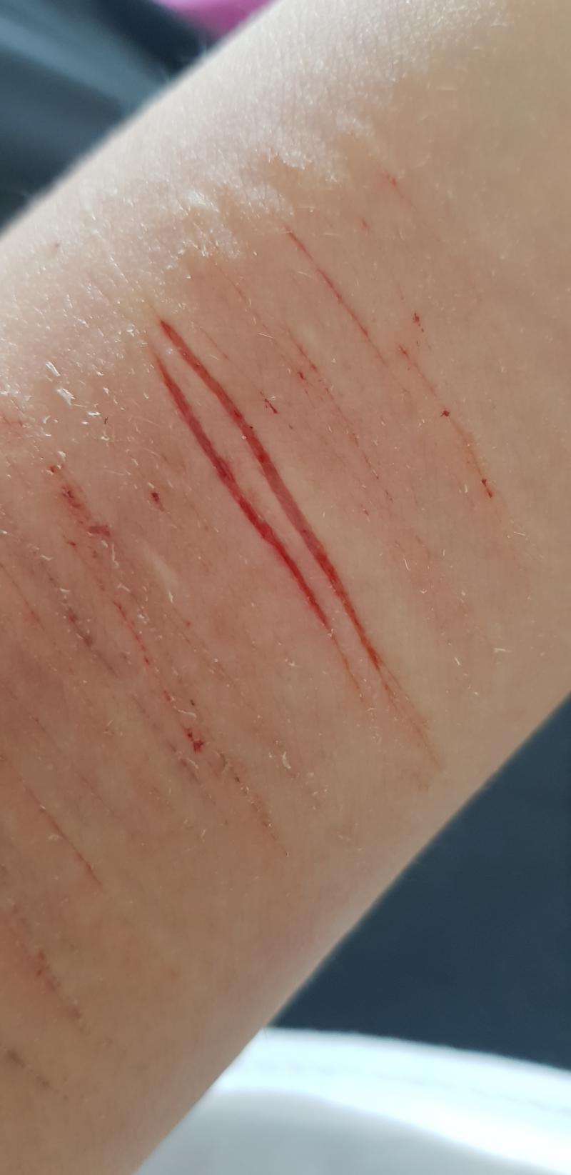 사진 주의해. 별로 징그럽진 않은데 보기 싫을 수도 있으니까. 이건 칼로 긋고, 벌려서 또 긋고 반복한거. 나머지는 칼로 한번씩만 그은것들.
