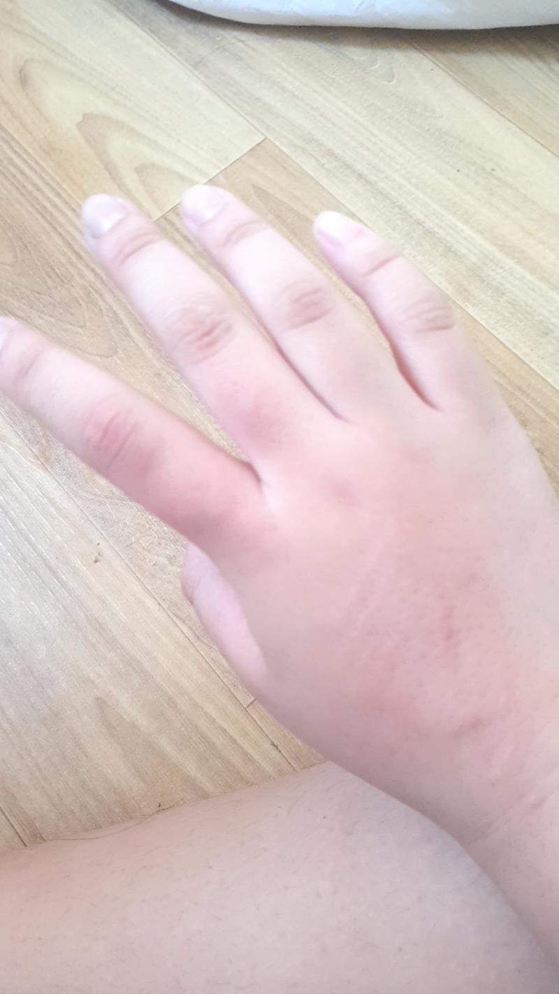 사진이 좀 붉게 나왔는데 실제로는 보랏빛 도는 멍이야 이정도면 며칠 정도 지나야 빠질거같어?대충 봤을때