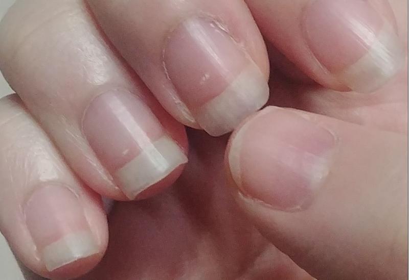 김치하다가 엄지손톱 칼로 썰었다... 손톱 없었으면 살 썰렸을걸...진짜 손톱 길러서 다행이라고 생각하는중ㅋㅋㅋㅋㅋㅋ왼쪽도 이상무! >>22 >