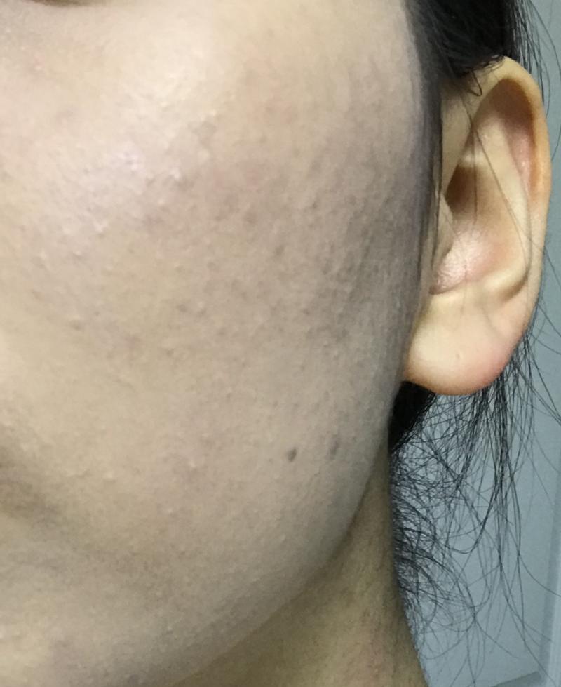 사실 화장후도 그렇게 감쪽같은 커버 뭐 이런건 아니지만 그래도 전에비하면 미친거같다 화장전사진 극혐이니까 보기전에 심호흡 해..