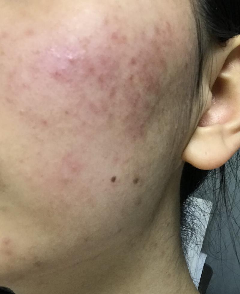 사실 화장후도 그렇게 감쪽같은 커버 뭐 이런건 아니지만 그래도 전에비하면 미친거같다 화장전사진 극혐이니까 보기전에 심호흡 해..