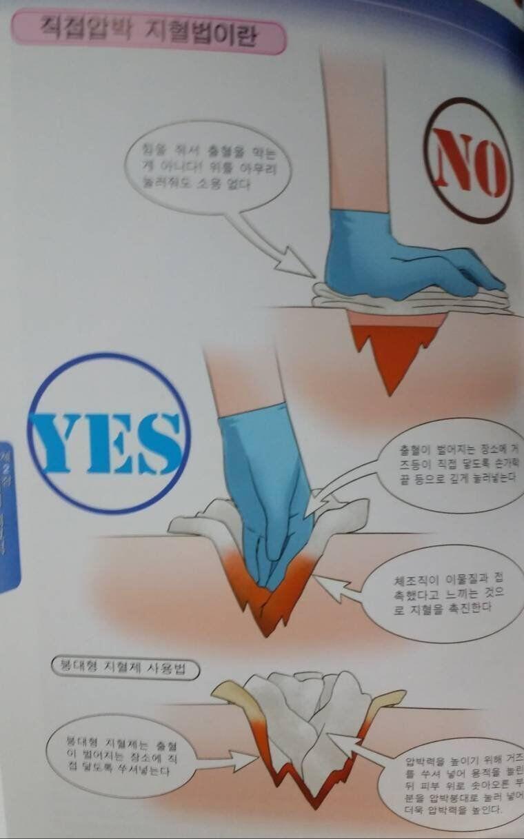 총상같은 상처를 지혈할때는 말 그대로 상처에 컴뱃거즈나 붕대를 쑤셔넣음 (짤주의)
