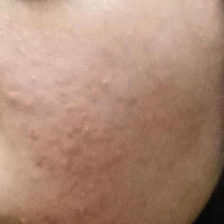 사진이 수ㄴ서대로 올라갔을지는 모르겠는데 점있는사진이 왼쪽볼이고 그 옆에가 오른쪽볼 머리카락라인 보이는 사진이 이마야 +초경을 초3때 해서인지 