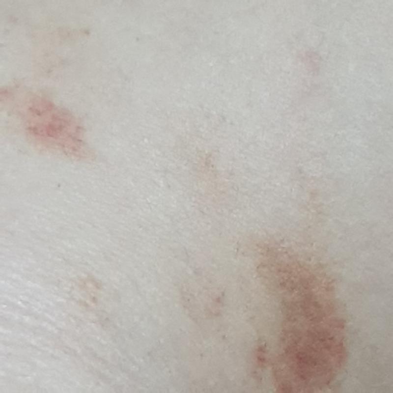 이건 목에있는거얍..ㅠ 다리엔 이것보다 2배정도 연한게 넓게있고 예전엔 안엔 좀 옅고 테두리는 짙은 동그라미였는데 요즘 좀 나아져서 그런지 여러