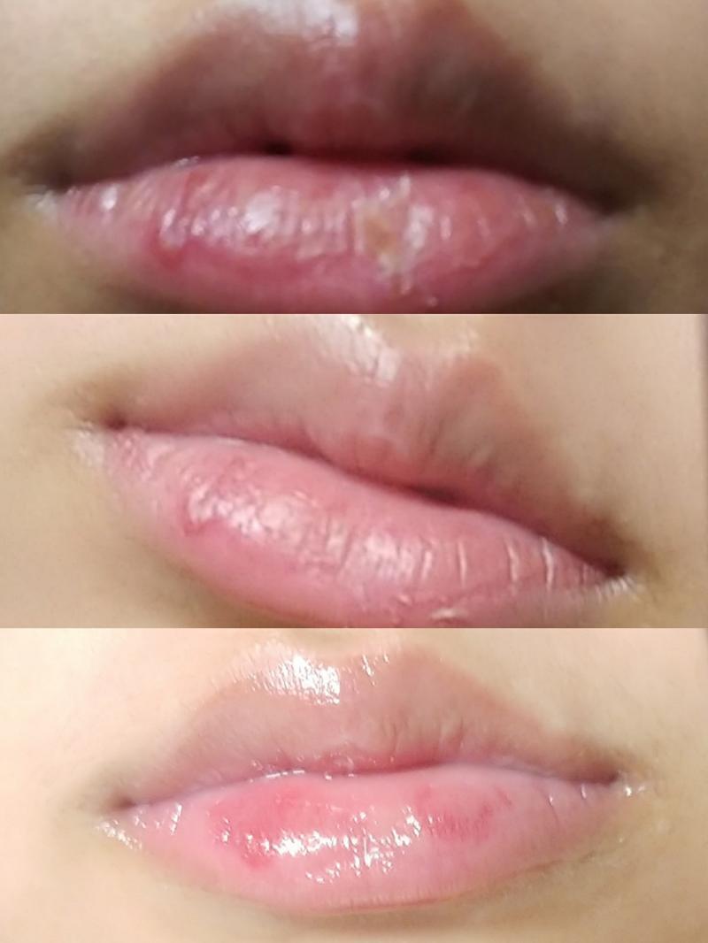 나 자랑할거 있어!!! 입술 각질 때문에 고민이었는데 요새 립밤 엄청많이 바르고 관리했더니 좀 나아졌다ㅎㅎ 사진 혐주의.. 위에서부터 비포 애프
