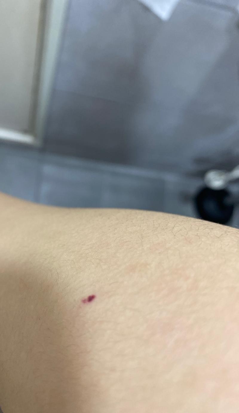 팔에 이렇게 자주색?이 갑자기 생겼어.