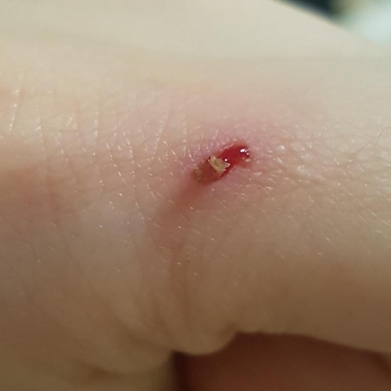 아 다 뜯고싶은데 아 너무 아파 아ㅠㅠ