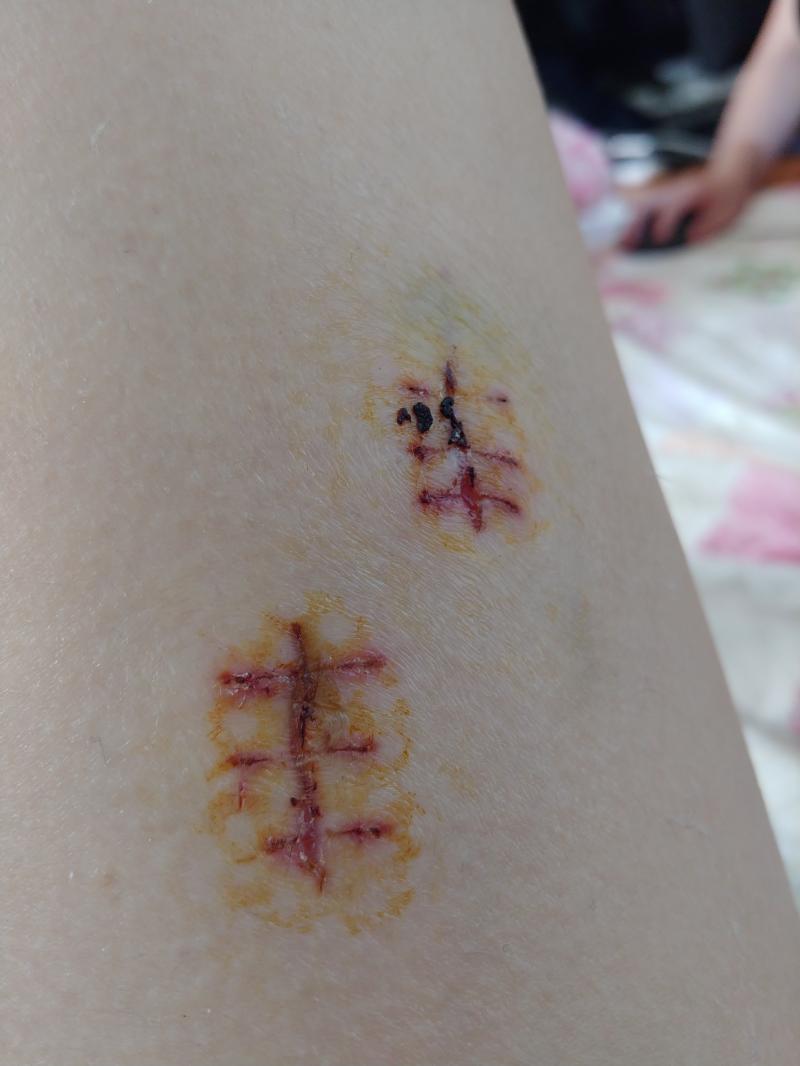 그리고 나 오늘부터 샤워가 가능해 드레싱도 땠어 오른쪽다리와 왼쪽다리 사진을 첨부해 혹시 약간이라도 혐오스러운 걸 못보는 사람이면 보지 않기를 