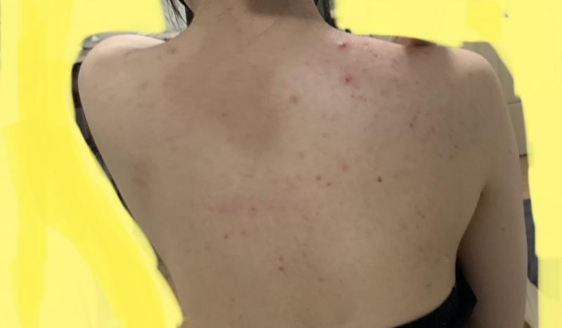 어제 찍은 사진이고 1번이 등이고 2번아 앞 쪽임 보다싶이 화농성 여드름도 많고 색소침칙이 크게 있고 증간중간에더 많음 진짜 스트레스고 나같은