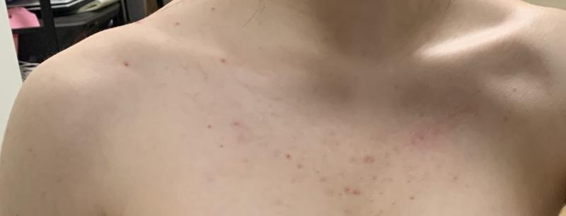 어제 찍은 사진이고 1번이 등이고 2번아 앞 쪽임 보다싶이 화농성 여드름도 많고 색소침칙이 크게 있고 증간중간에더 많음 진짜 스트레스고 나같은