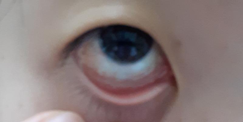 4,5 둘 다 나야ㅋㅋ 나도 사진 보여줄게 혐주의.. 내가 말한 흰 선이 이거야 아래 다 부은 거구