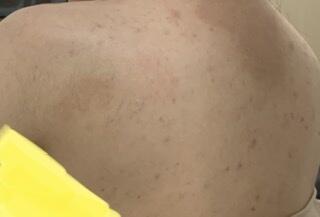 사진 더러움 주의) 이틀 지나서 찍은 건데 솔직히 변화는 없어 그냥 하는 중이라고 올리려고... 일단 내가 어떻게 하는 중인지 적을게 샤워는 매