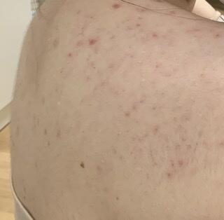 사진 더러움 주의) 이틀 지나서 찍은 건데 솔직히 변화는 없어 그냥 하는 중이라고 올리려고... 일단 내가 어떻게 하는 중인지 적을게 샤워는 매