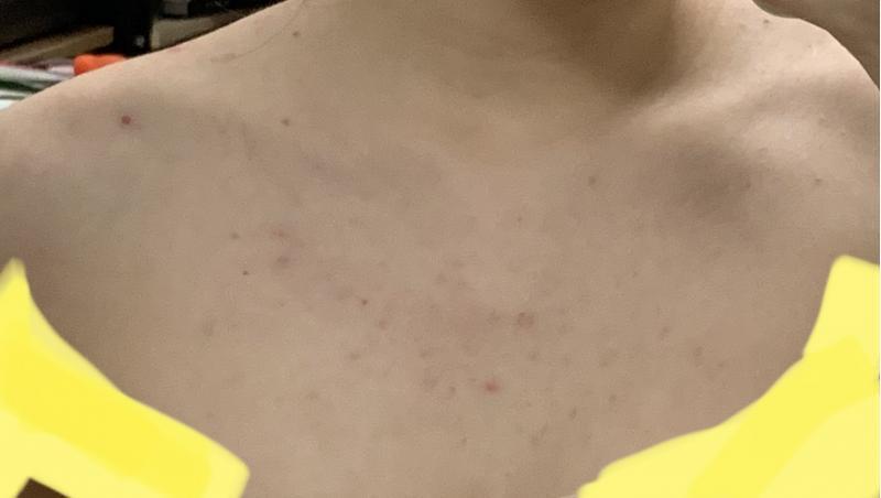 사진 더러움 주의) 이틀 지나서 찍은 건데 솔직히 변화는 없어 그냥 하는 중이라고 올리려고... 일단 내가 어떻게 하는 중인지 적을게 샤워는 매