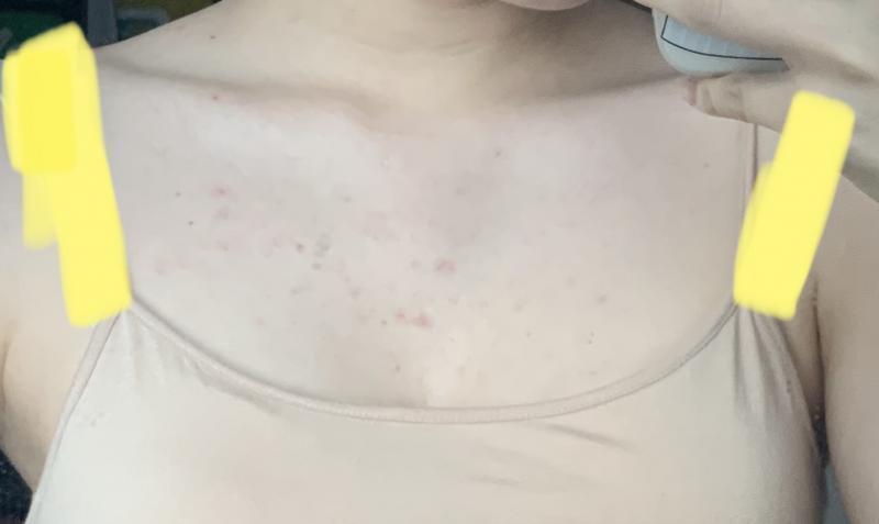 오늘 아침에 찍은 건데 앞쪽은 확실히 좋아진 거 같아 불행중 다행인지 앞쪽은 색소침착이 적어서 다행이야... 확실히 매일 씻어준 게 효과가 있었