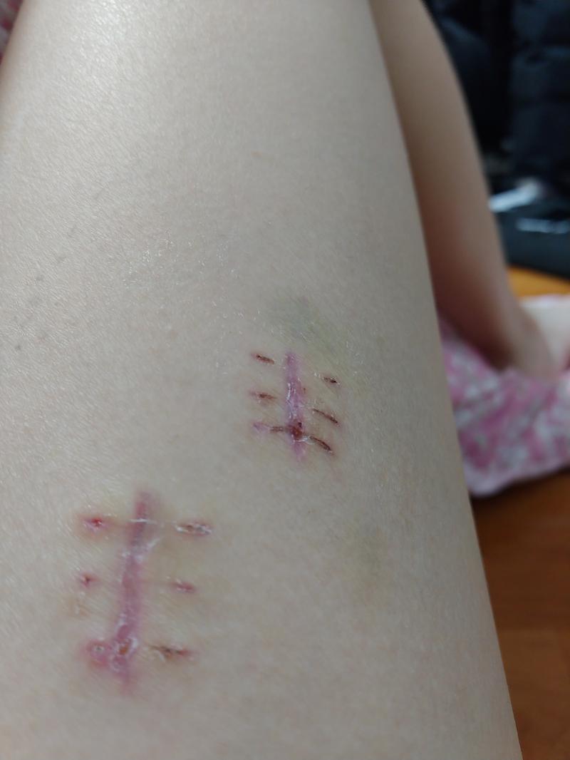 오른쪽 다리를 주무르니까 아파... 아직 다리가 완전히 안 나았나봐 아직 오른쪽 다리가 감각이 없긴 하지만...