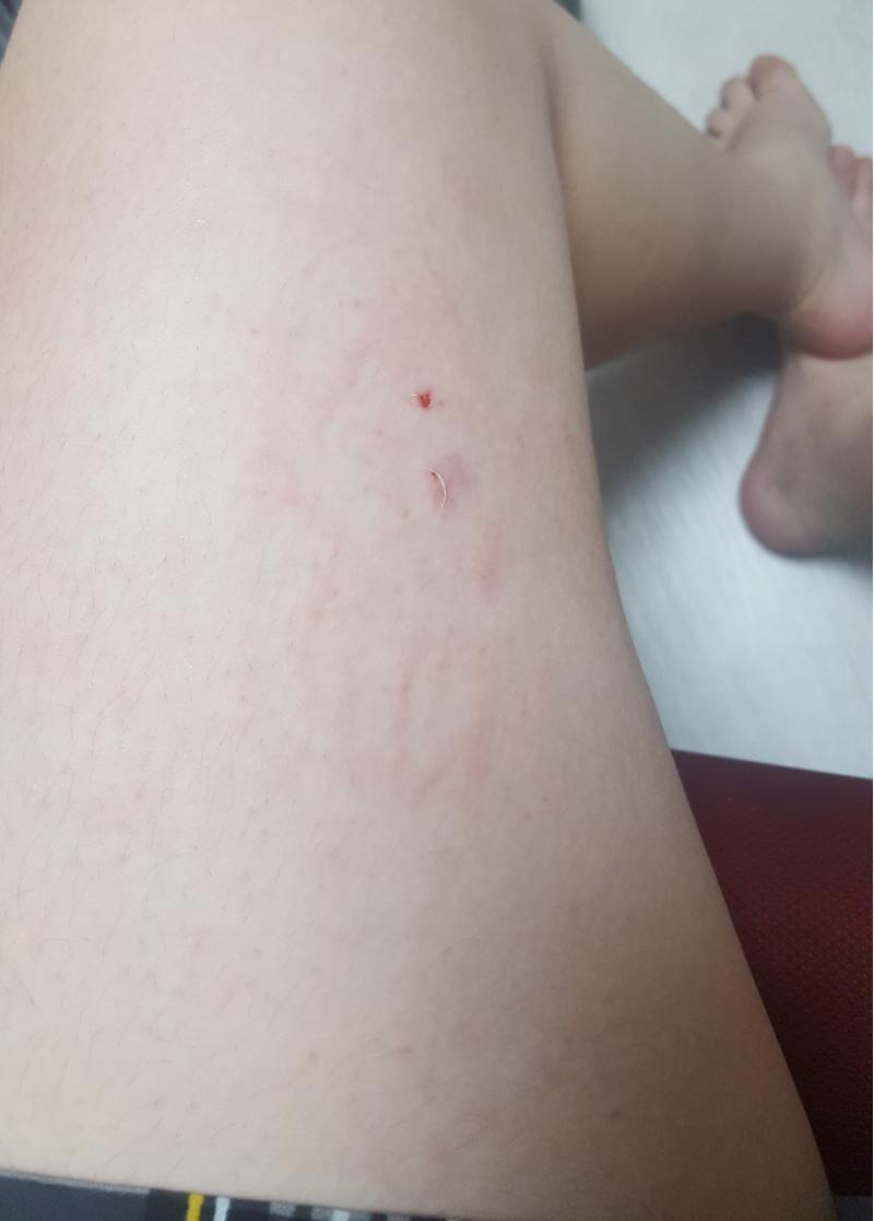 이런 거 함부로 올려도 되려나... 다리 맞은 건데 참고로 허리도 맞고 목도 맞음. 지금은 피멍이 약간 보라색이랑 붉은색 섞여 있다.