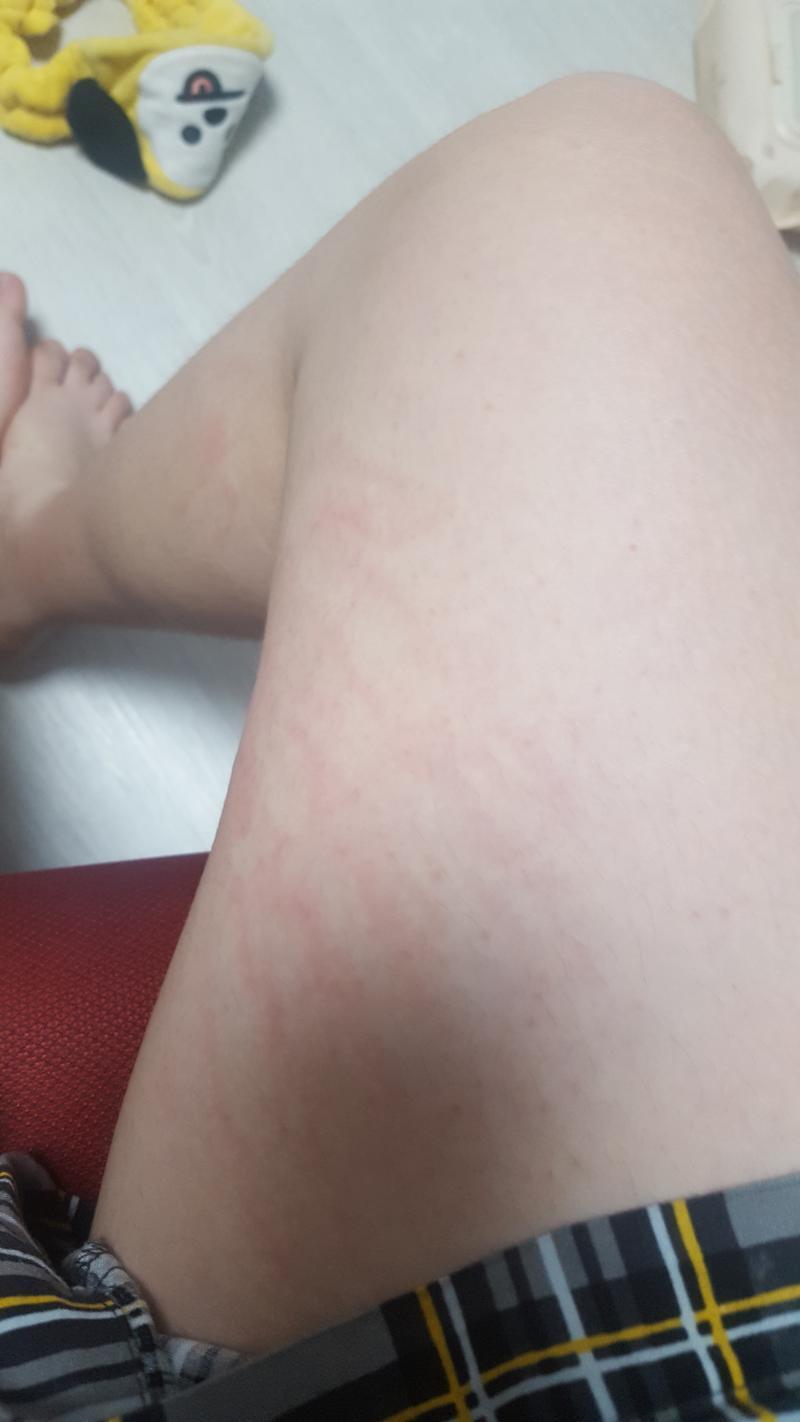 이런 거 함부로 올려도 되려나... 다리 맞은 건데 참고로 허리도 맞고 목도 맞음. 지금은 피멍이 약간 보라색이랑 붉은색 섞여 있다.