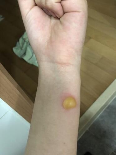내가 제일 레전드 아닐까 생각해본다 새벽에 부스스하게 일어나서 똥싸다 물집 발견하고 차분하게 사진찍음 ㅋㅋㅋㅋㅋ 밑에 사진은 2년 지난 지금 근