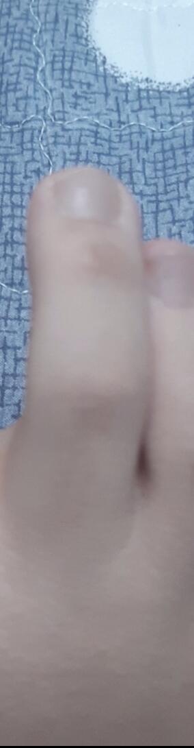 음...난 구두 오래 신어서 두번째 발가락 각각 물집 크게 잡혀서 그대로 뒀더니 굳은살?같이 남았더라구(사진 첨가) 그리고 나 중3때 한 5월달