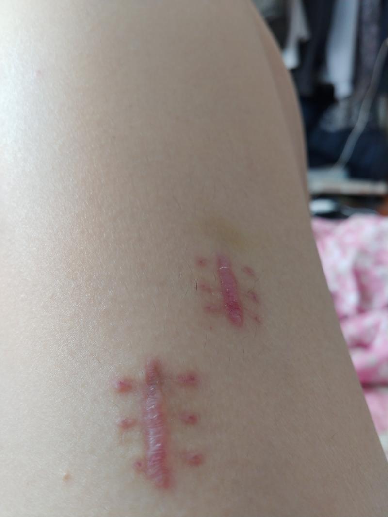 수술부위가 처음에 드레싱 땐 이후로 좀 부은것 같아 이거 흉터 관리는 어떻게 해야하나?