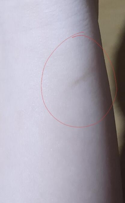 첫번째껀 흉터도 두번째꺼는 최근에 대여서 아직 빨감. 둘다 요리하다가 냄비나 그런거 사이드에 붙어서 대였는데 물로만 헹구고 다른 조치 안취해서