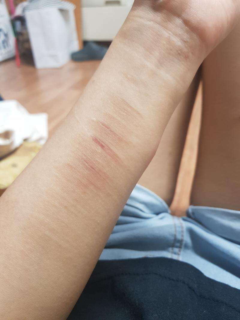 사진은 사이즈 참고하라고... 흉터 보기 싫으면 보면 안 돼!